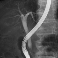 ERCP